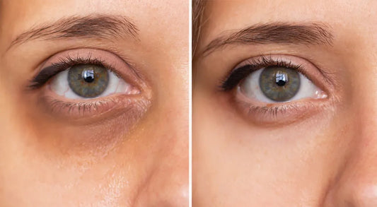 Remove Dark Circles Permanently!